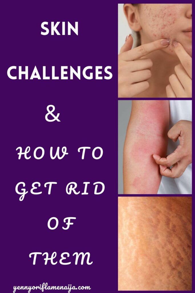 SKIN Challenges & Solutions